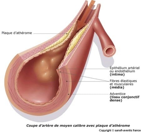 Athérosclérose - Pôle vasculaire et endovasculaire Saint-Martin