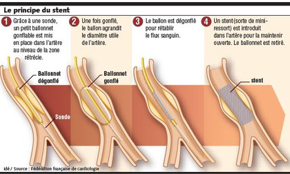 Angioplastie - Pôle vasculaire et endovasculaire Saint-Martin