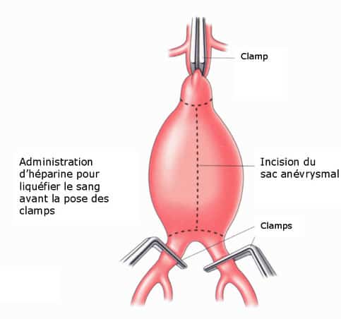 Anévrisme de l'aorte abdominale : réparation chirurgicale - Pôle ...